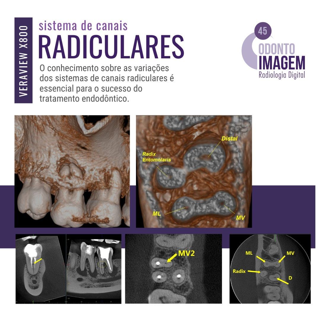 sistema-de-canais-radiculares