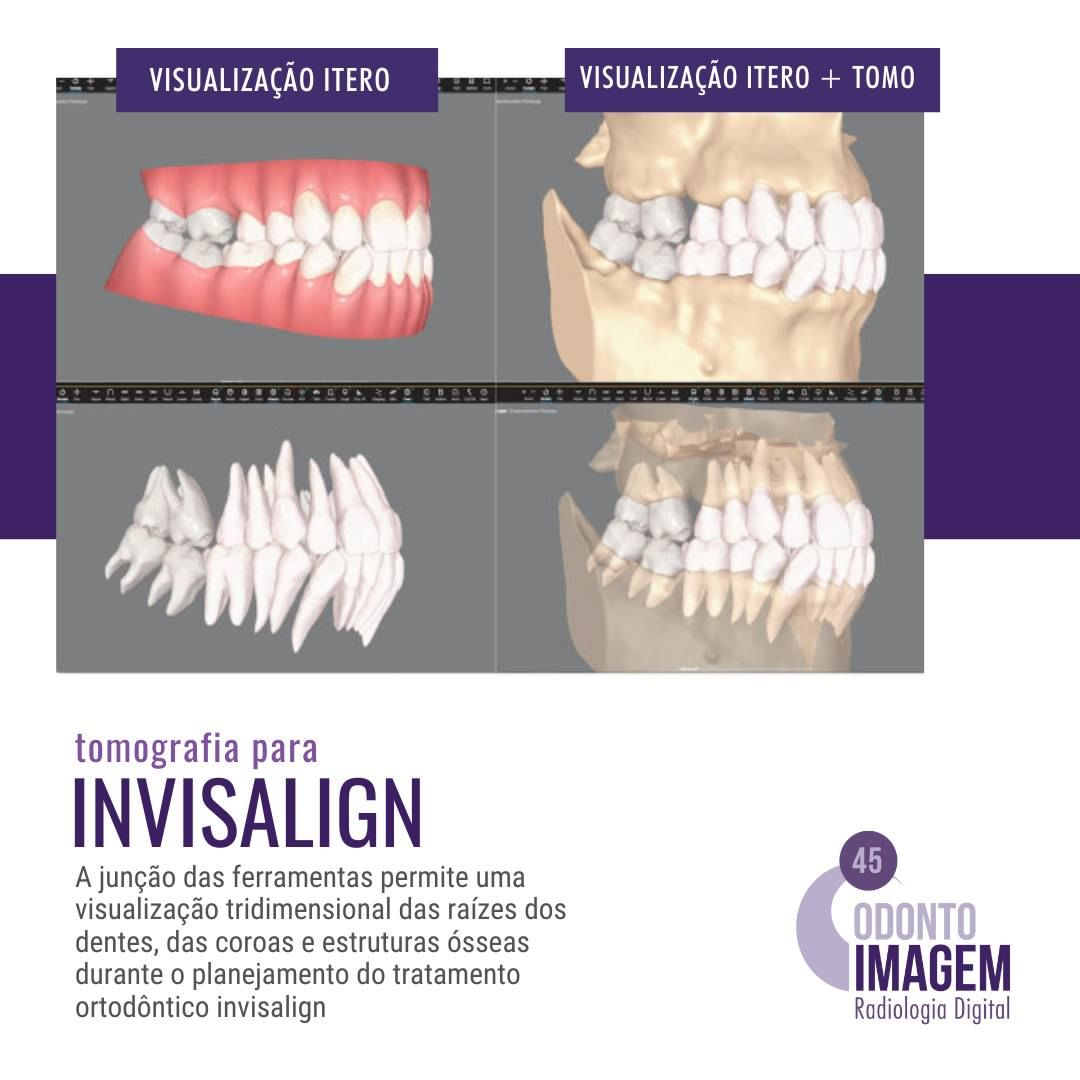 tomografia-para-invisalign