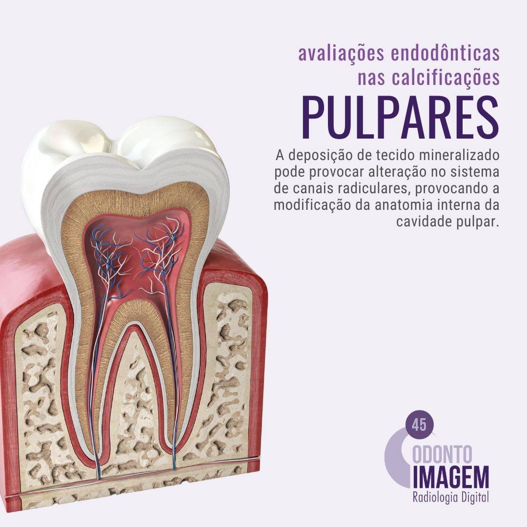 avaliacoes-endodonticas-nas-calcificacoes-pulpares