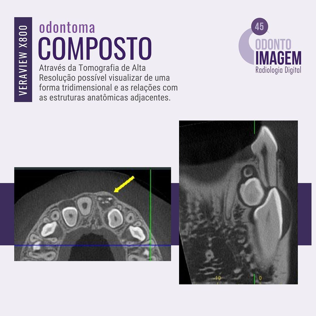 odontoma-composto