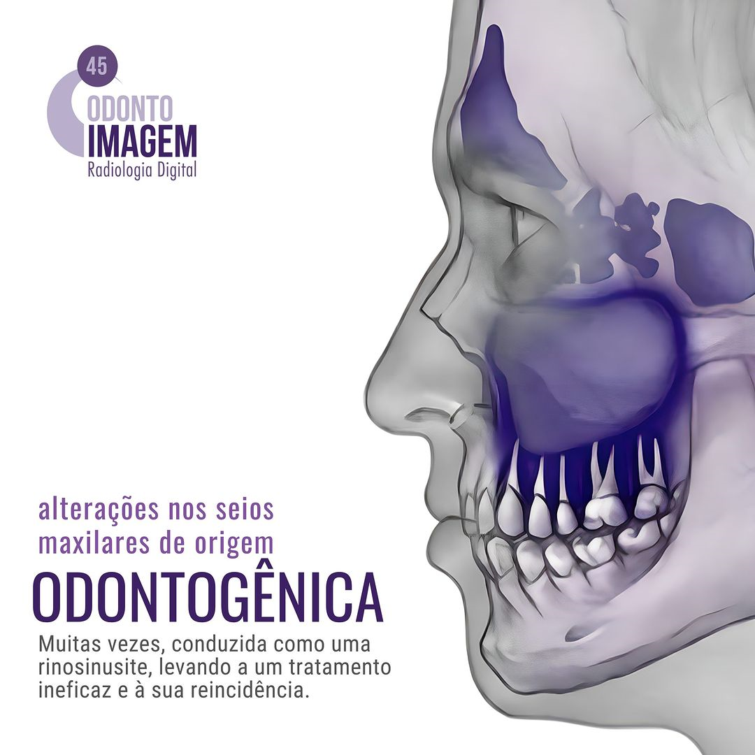 alteracoes-nos-seios-maxilares-de-origem-odontogenica