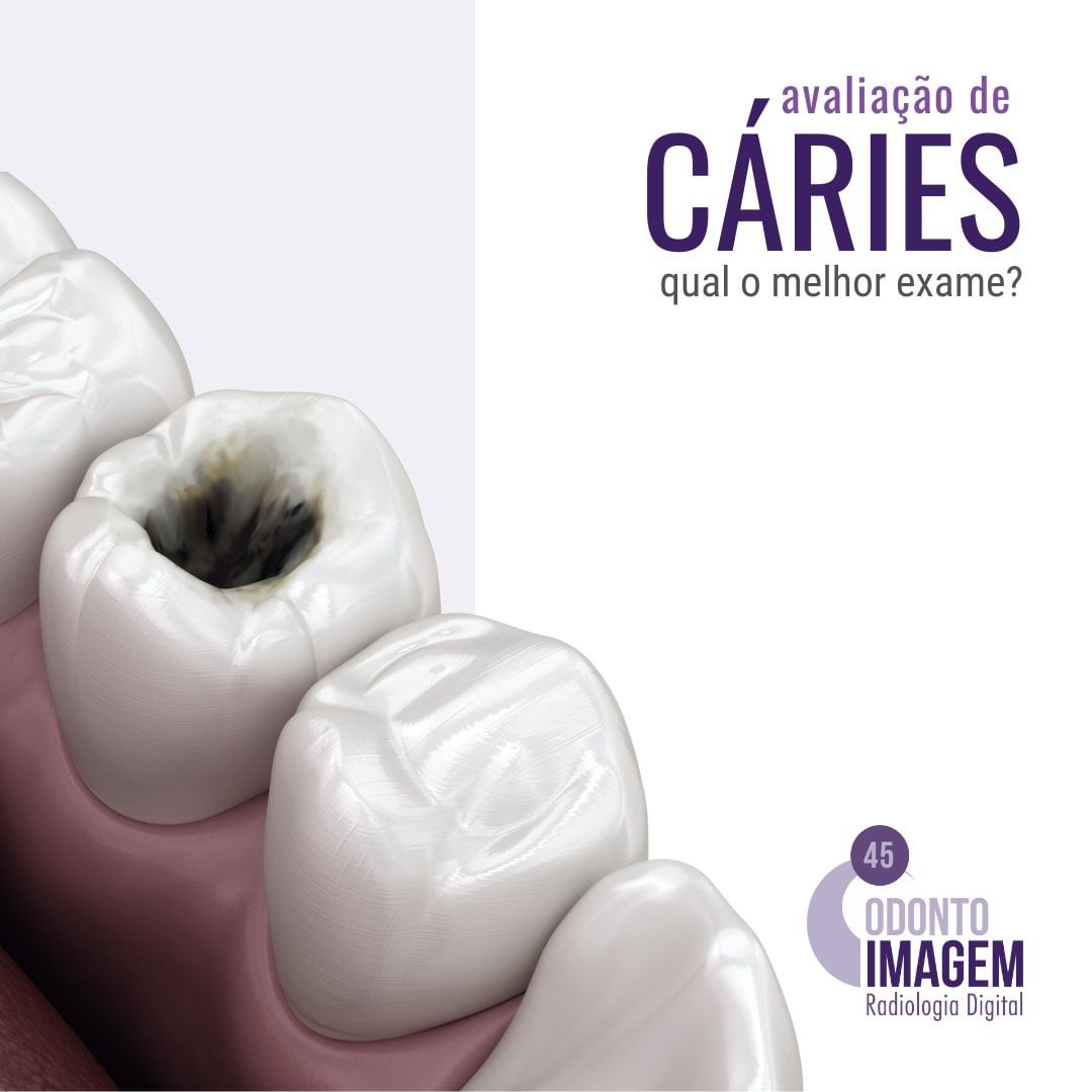 avaliacao-de-caries