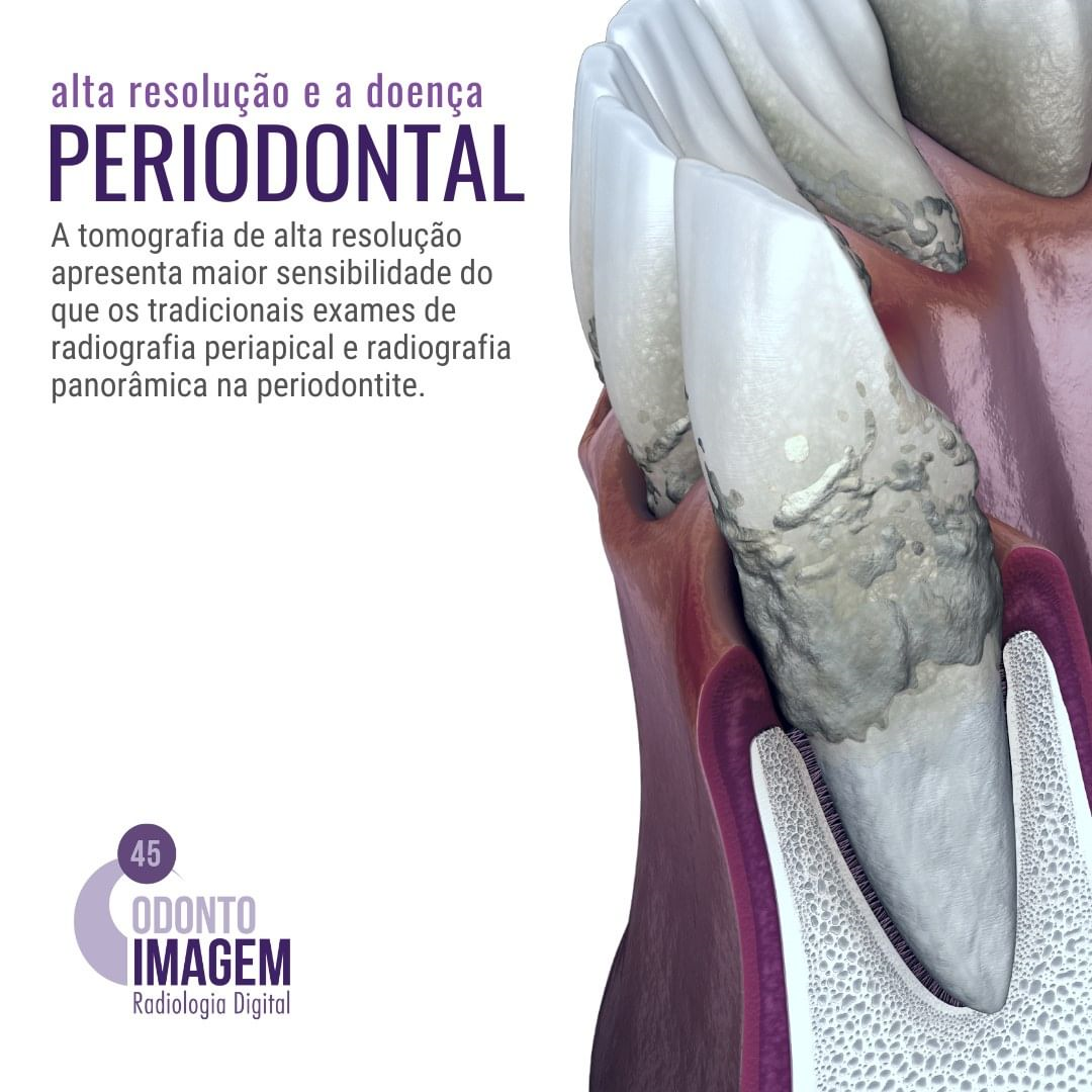 alta-resolucao-e-a-doenca-periodontal