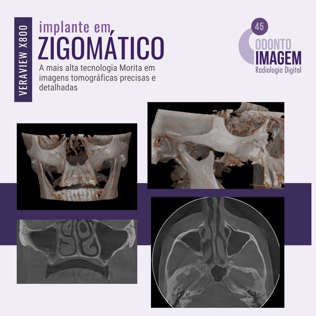 implante-em-zigomatico