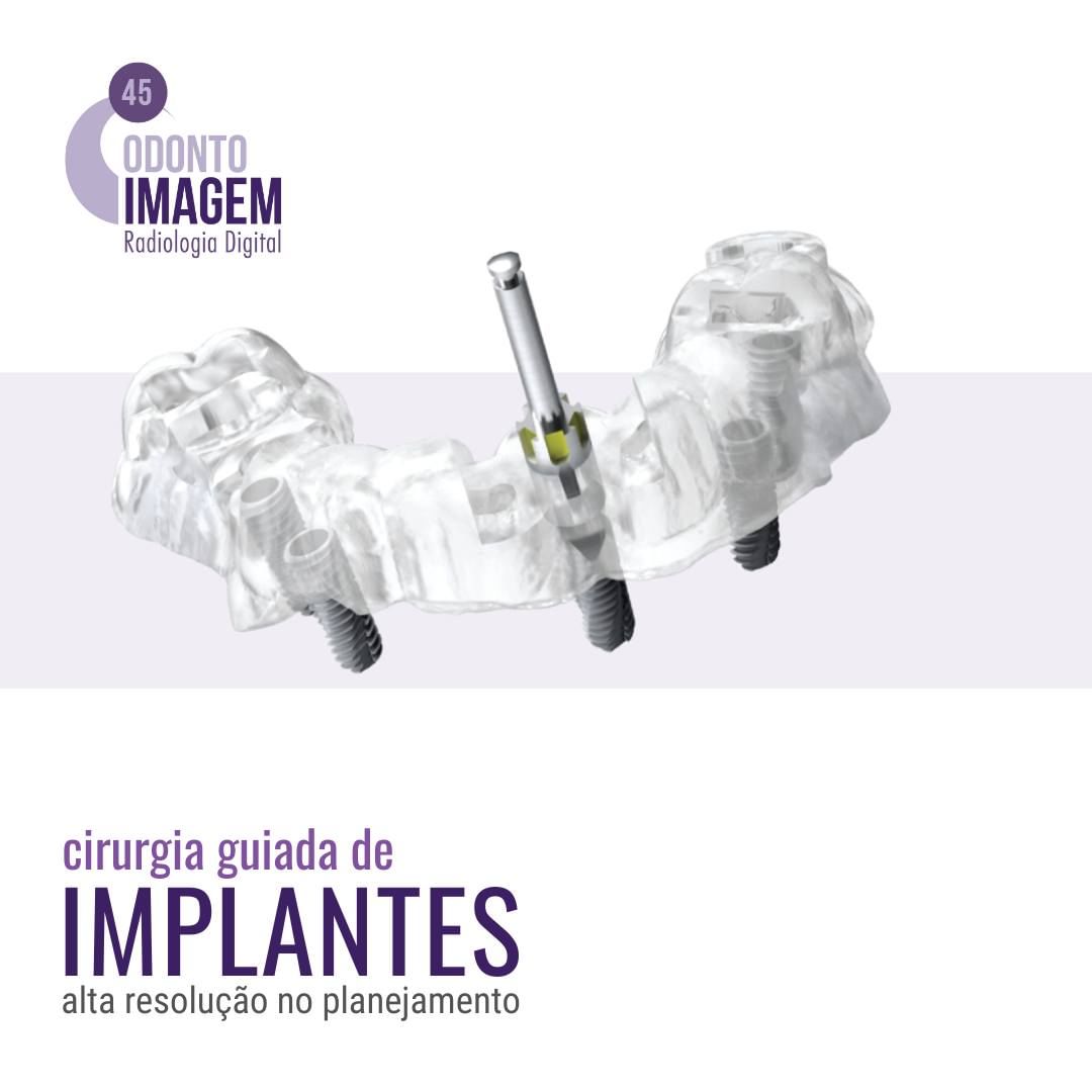 cirurgia-guiada-de-implantes