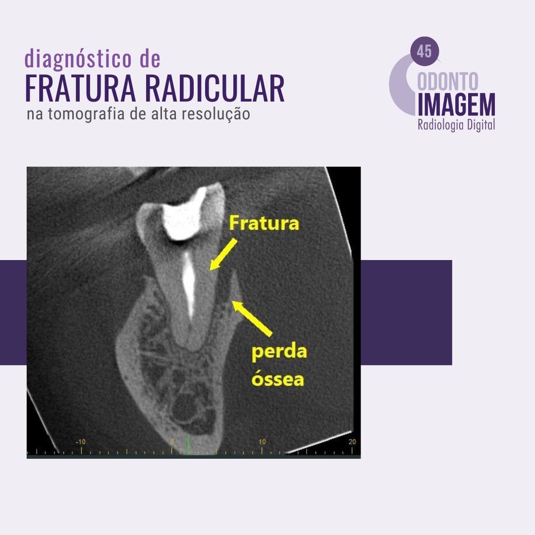 diagnostico-de-fratura-radicular