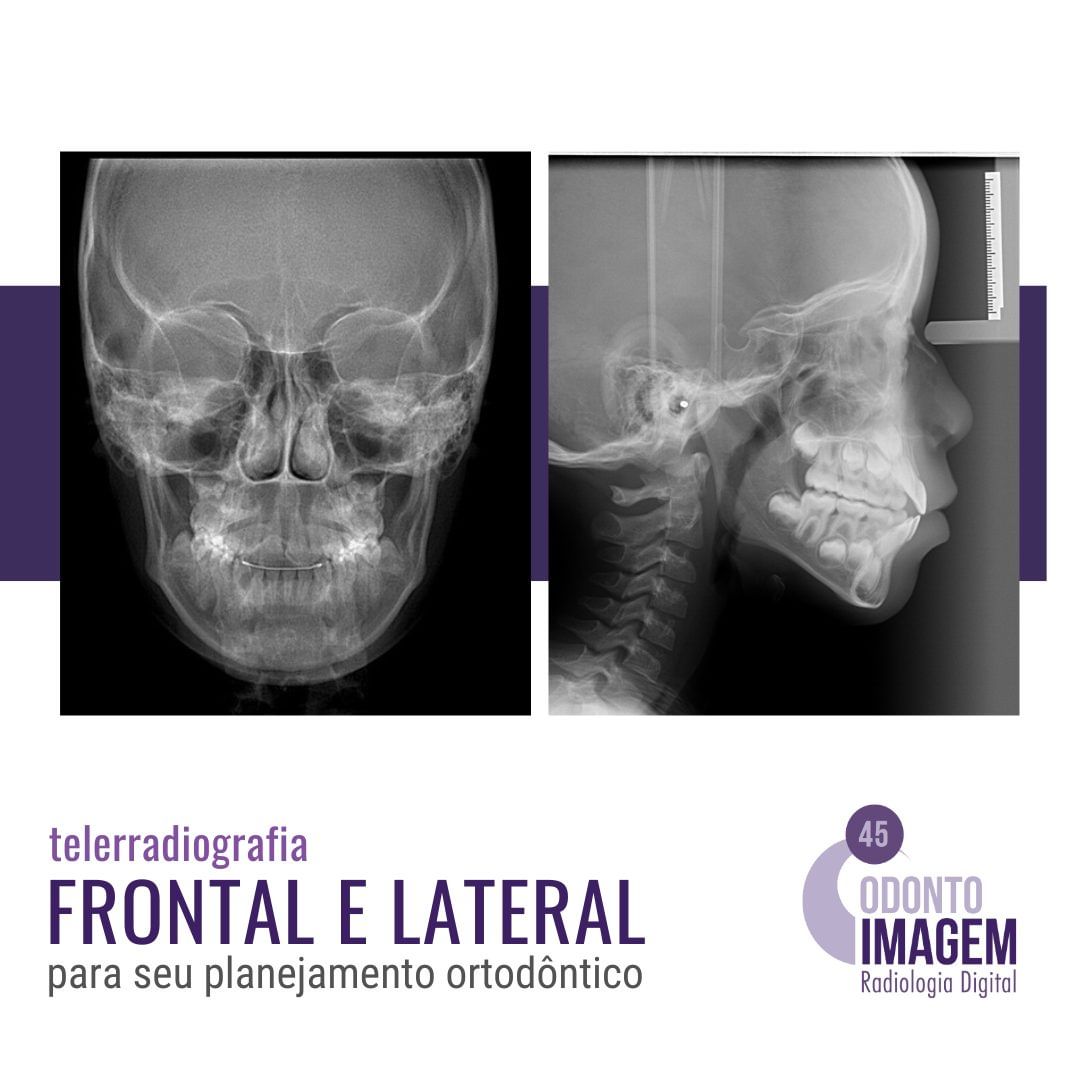 telerradiografia-frontal-e-lateral