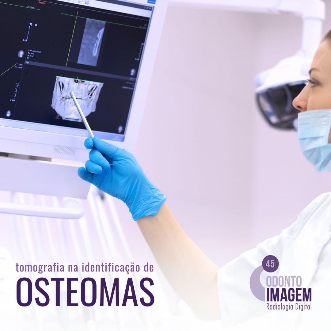 tomografia-na-identificacao-de-osteomas