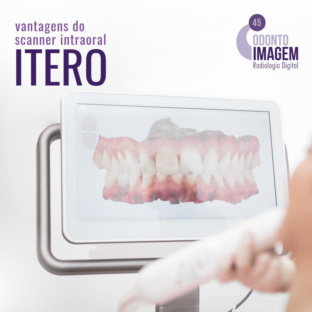 vantagens-do-scanner-intraoral-itero