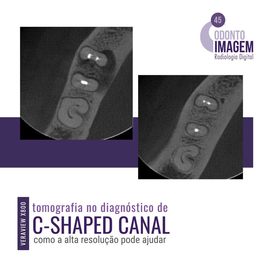 tomografia-no-diagnostico-de-c-shaped-canal