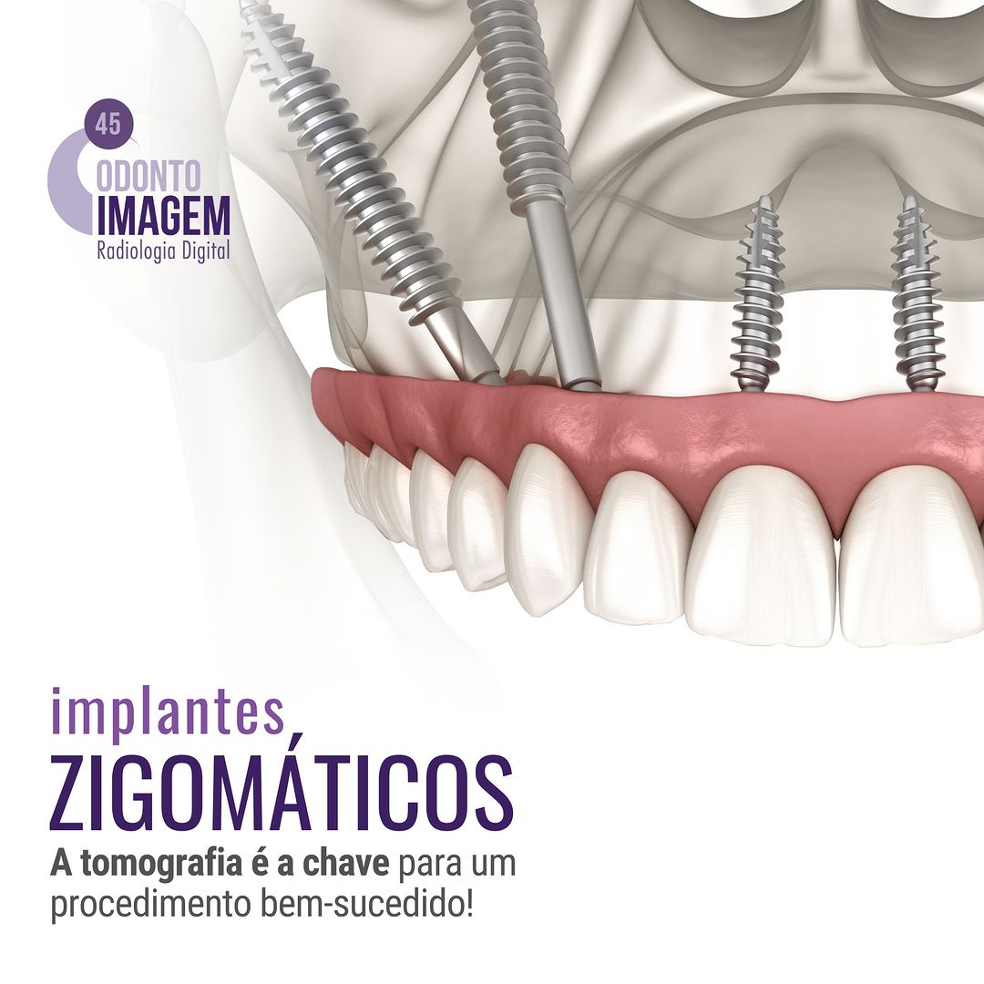 implantes-zigomaticos