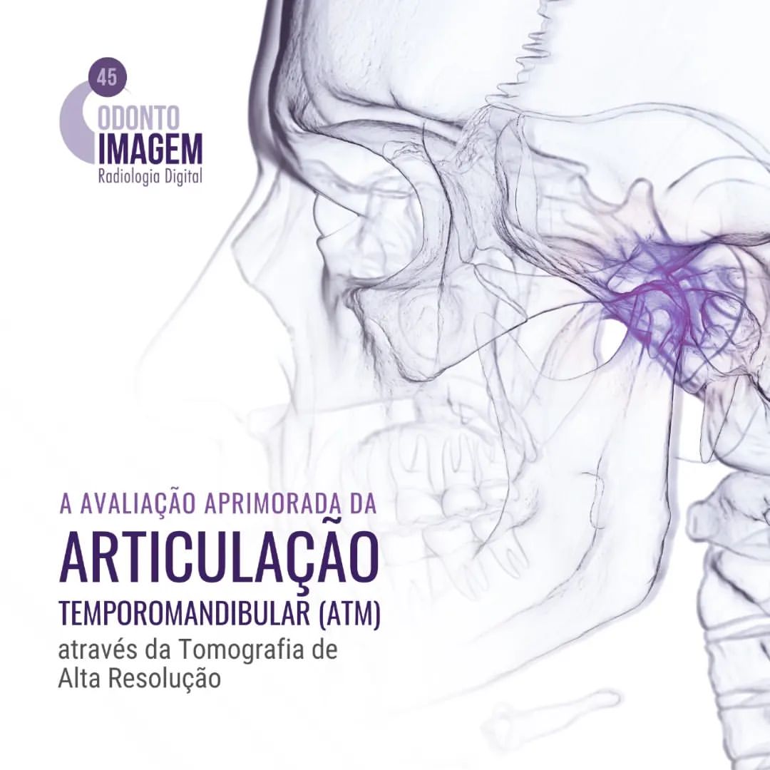 Na intersecção entre a inovação tecnológica e o cuidado odontológico encontra-se a tomografia de alta resolução. Sua relevância no estudo da articulação temporomandibular (ATM) não pode ser subestimada. Compreender e diagnosticar as nuances dessa complexa articulação exige uma visualização detalhada e precisa, e é aqui que a tomografia de alta resolução se torna uma ferramenta indispensável. A ATM é uma estrutura delicada, composta de várias partes inter-relacionadas. Com a tomografia de alta resolução, os profissionais podem obter visualizações tridimensionais nítidas, permitindo uma interpretação mais aprofundada das estruturas da ATM. Além disso, a capacidade de identificar alterações sutis, sejam elas deslocamentos de disco, artroses ou outras condições degenerativas, significa que os dentistas estão mais bem equipados para fazer intervenções assertivas. Não se trata apenas de detectar problemas, mas de entender sua origem e evolução. Quando se considera procedimentos cirúrgicos envolvendo a ATM, a precisão é primordial. Ter acesso a imagens de alta definição garante ao dentista um entendimento mais abrangente da área a ser trabalhada. Isso se traduz em intervenções mais seguras e resultados previsíveis. O monitoramento evolutivo de condições associadas à ATM também se beneficia. Com a tomografia de alta resolução, os dentistas podem rastrear a progressão de uma condição com uma clareza sem precedentes, avaliando a eficácia dos tratamentos ao longo do tempo. Convidamos você, dentista, a experimentar essa revolução em imagem na Odonto Imagem, onde a inovação e o cuidado se unem para oferecer o melhor para sua prática clínica. Entre em contato e descubra como podemos auxiliar em sua jornada de diagnóstico e tratamento.