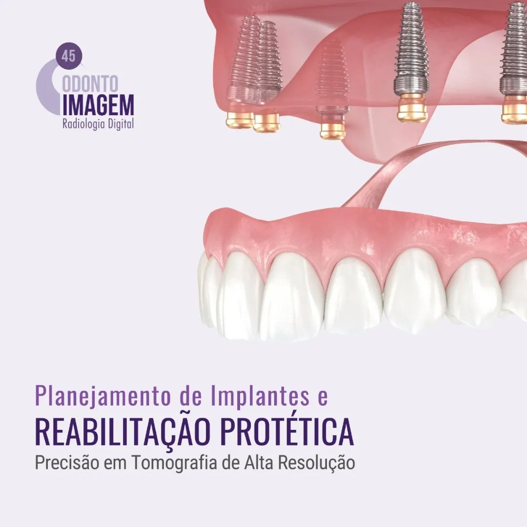 planejamento-de-implantes-e-reabilitacao-protetica