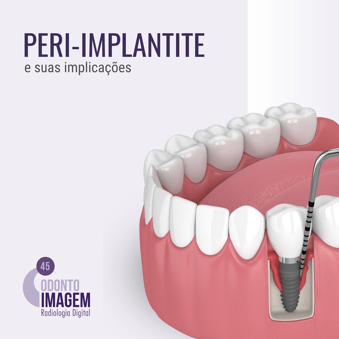 PERI IMPLANTE Odonto Imagem