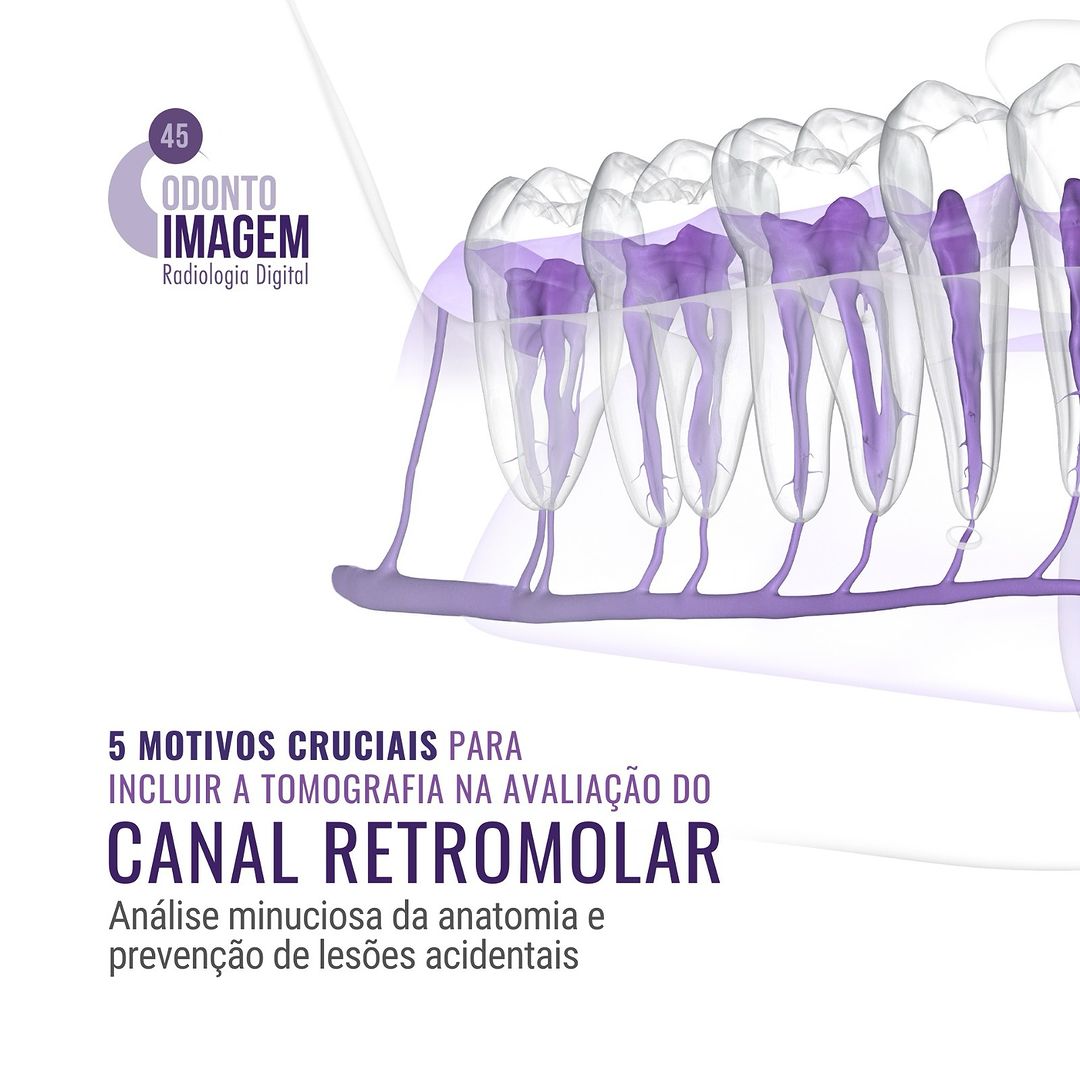 5-motivos-cruciais-para-incluir-a-tomografia-na-avaliacao-do-canal-retromolar