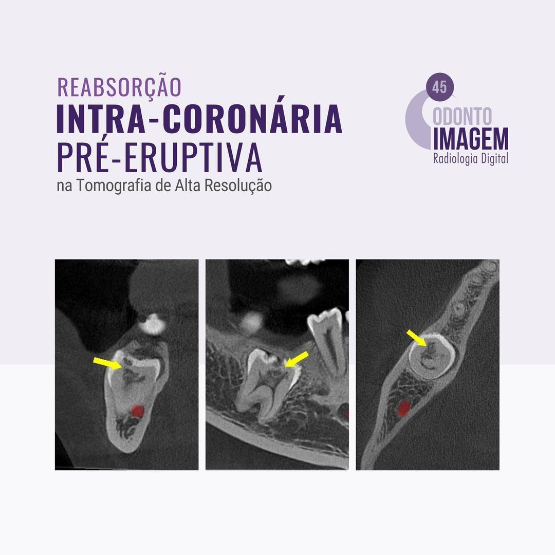 reabsorcao-intra-coronaria-pre-eruptiva