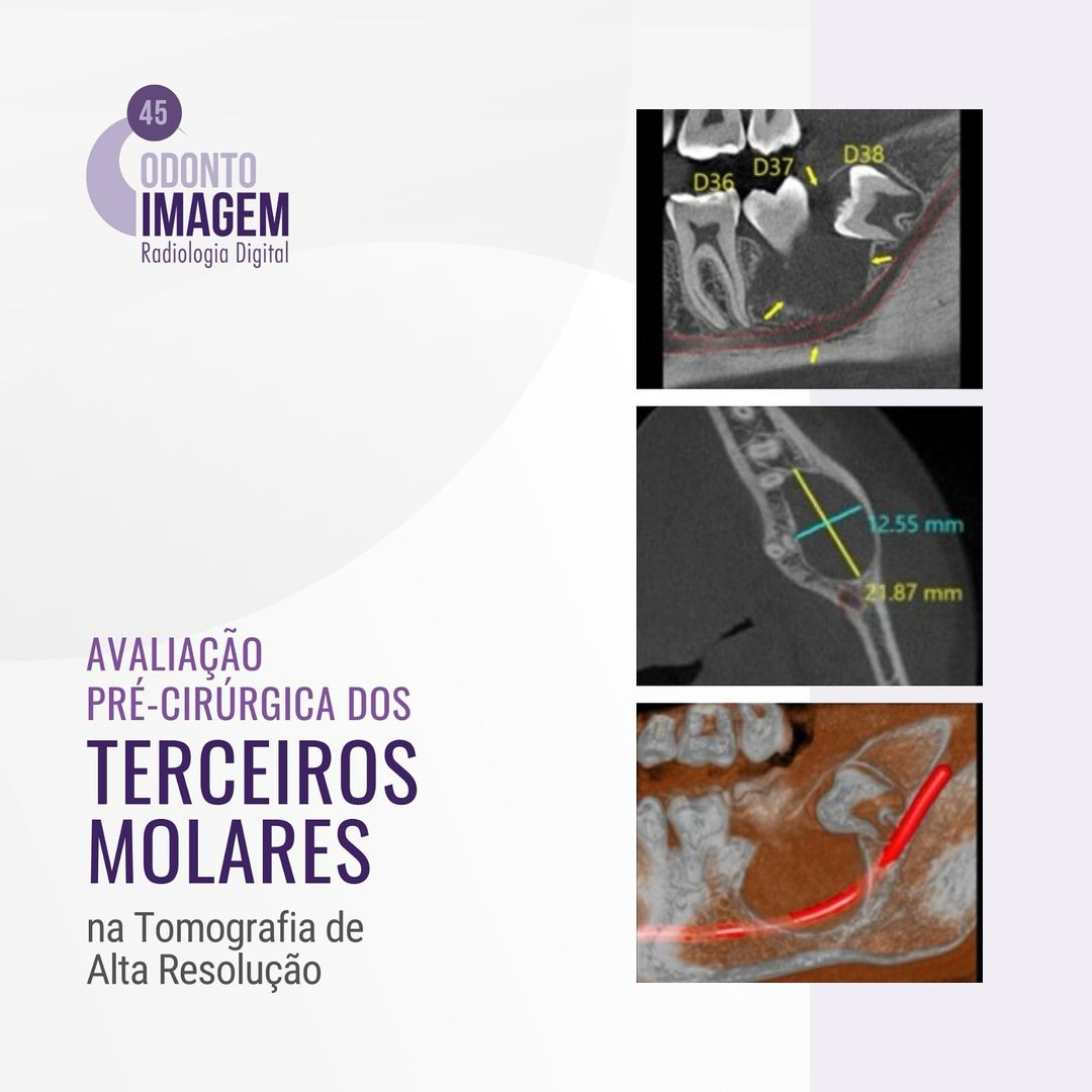 avaliacao-pre-cirurgica-dos-terceiros-molares