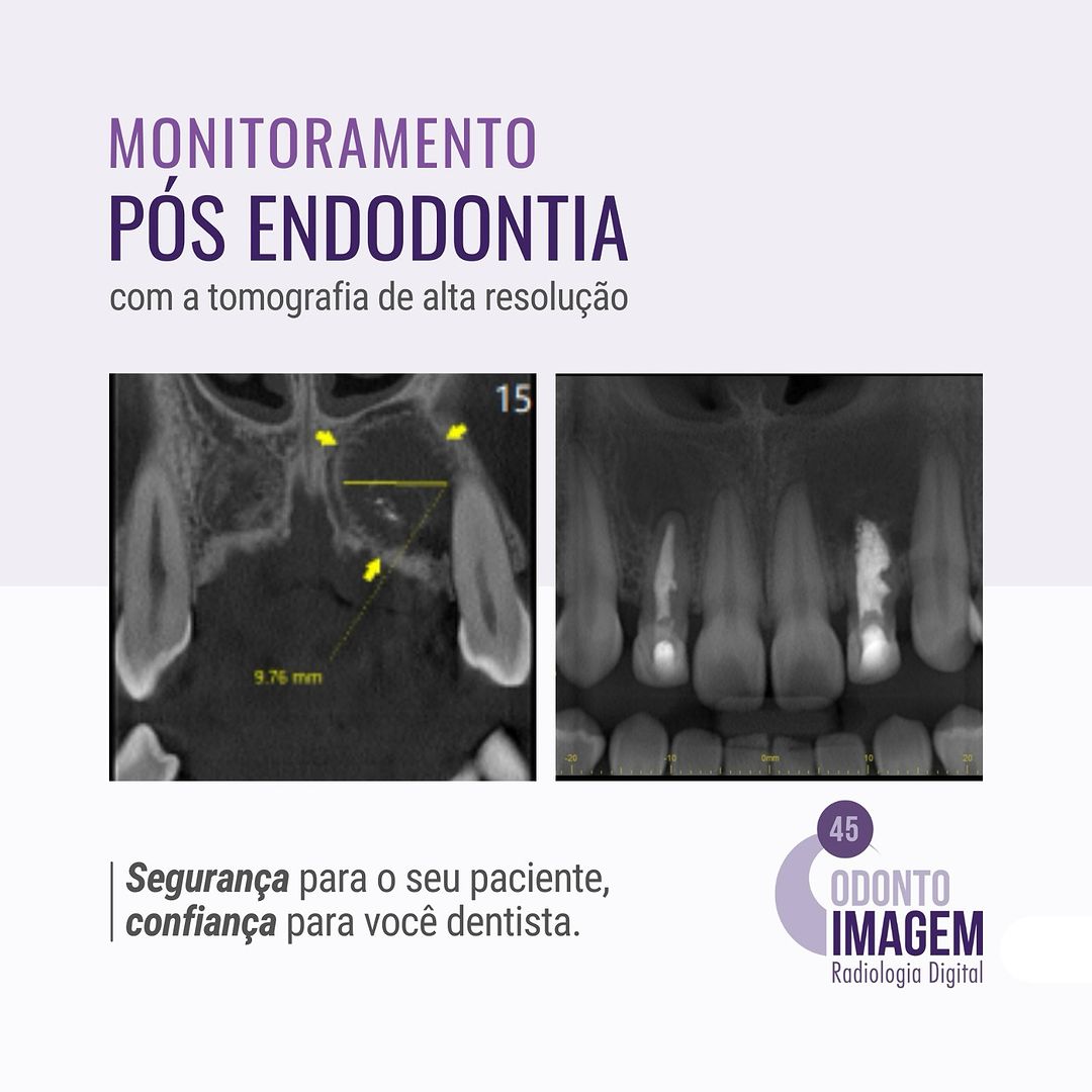 monitoramento-pos-endodontia