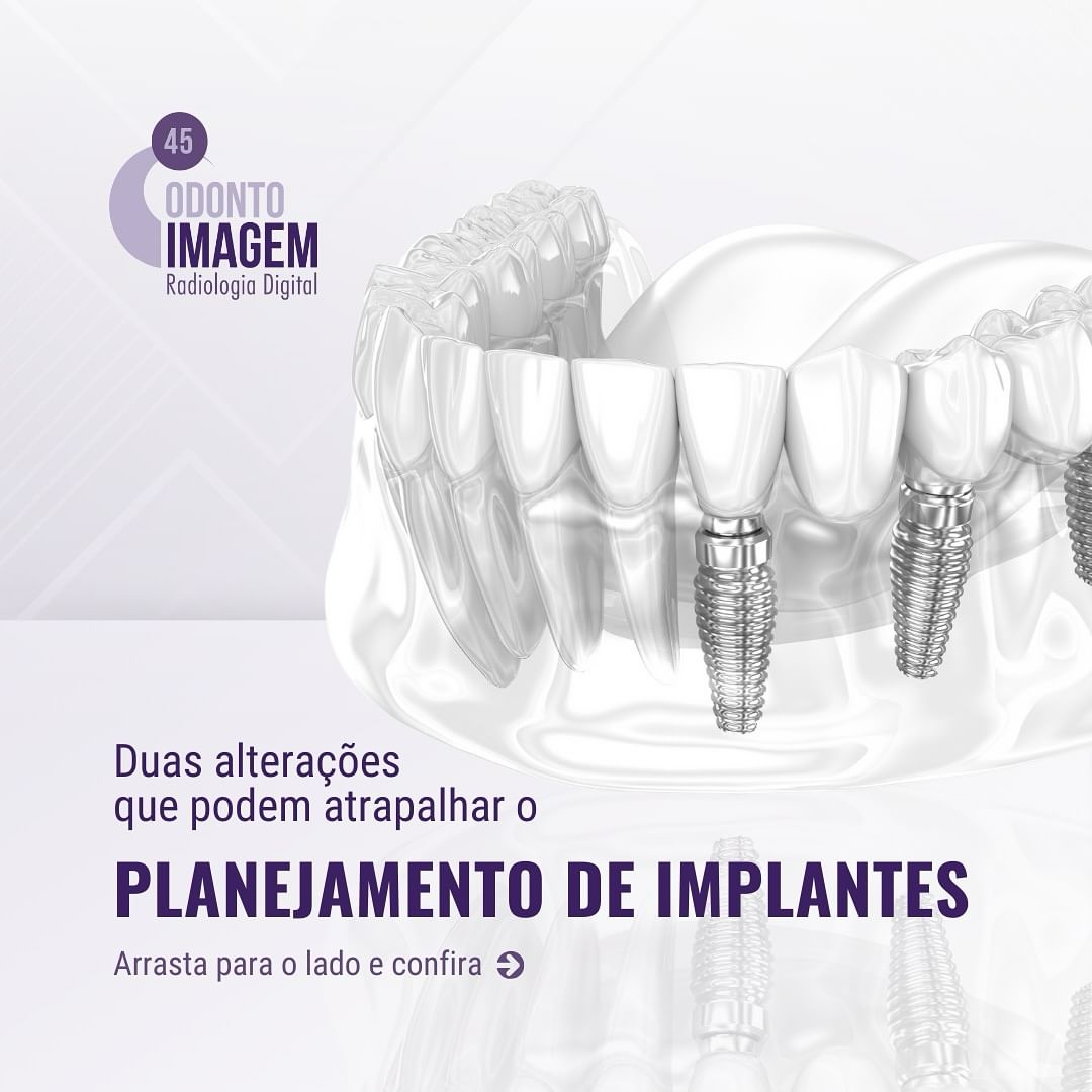 planejamento-de-implantes