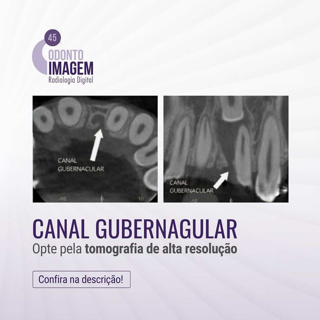 o-canal-gubernacular