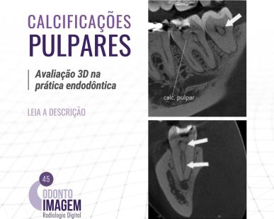 calcificacoes-pulpares