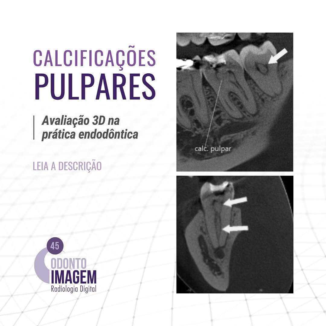 calcificacoes-pulpares