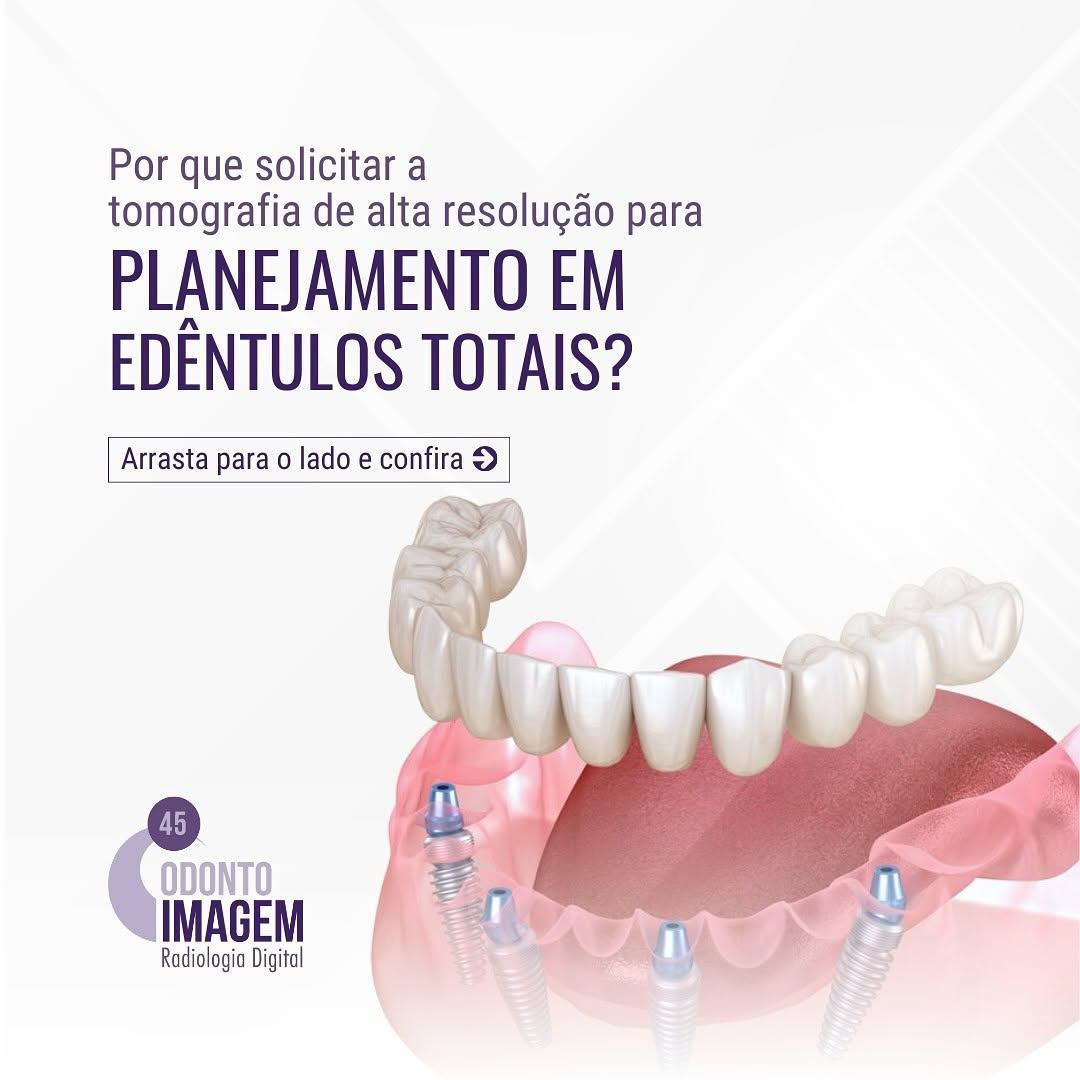 planejamento-em-edentulos-totais