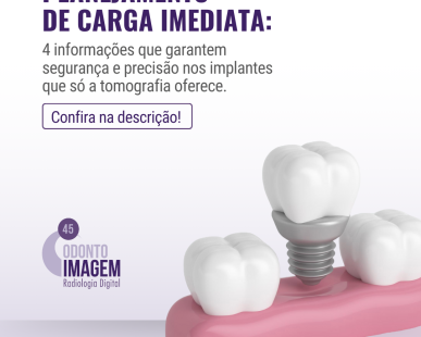 planejamento-de-carga-imediata