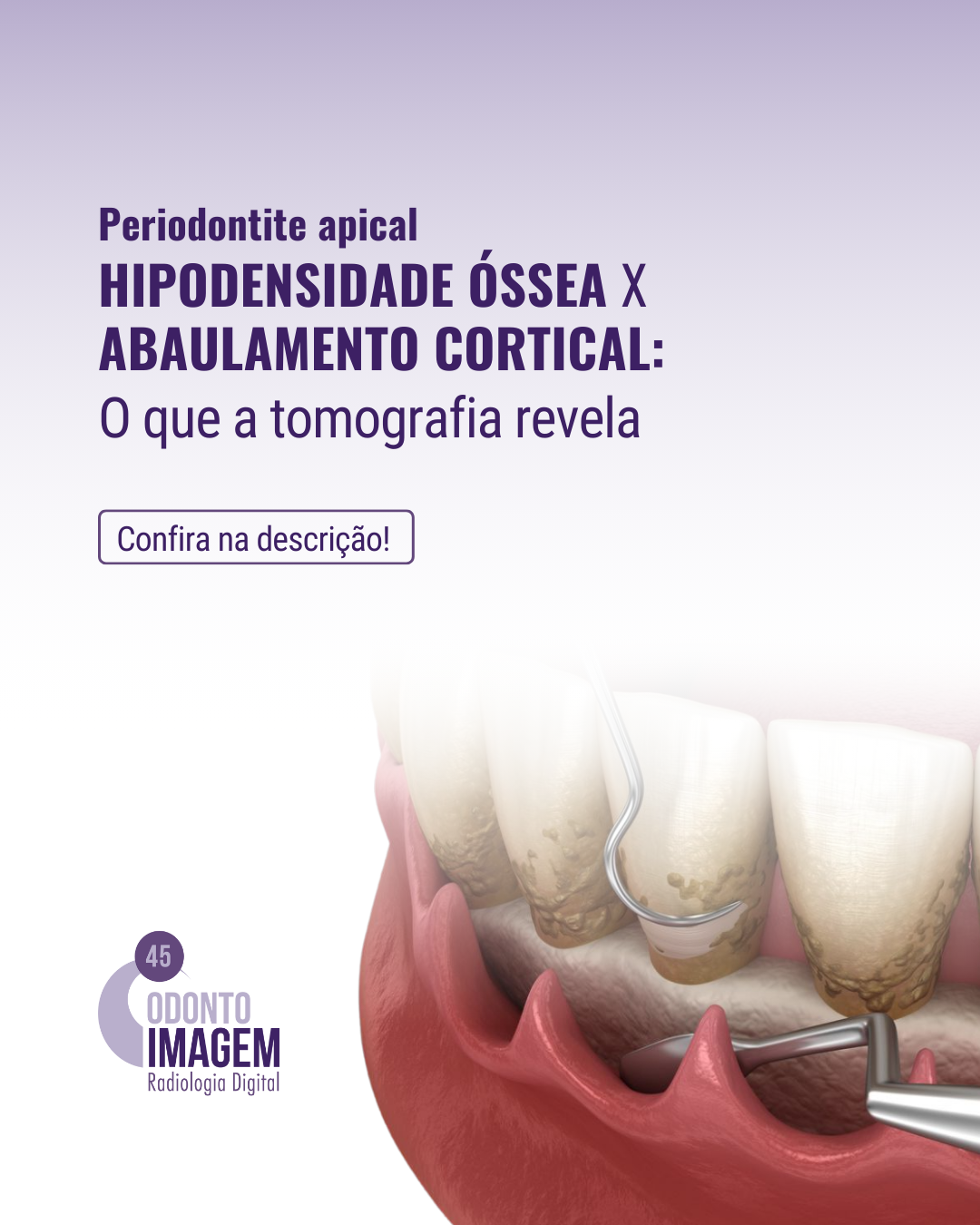 hipodensidade-ossea-x-abaulamento-cortical