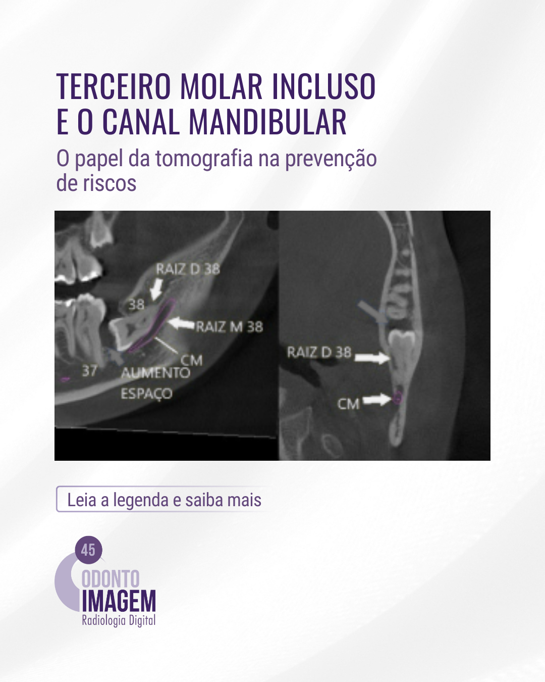 terceiro-molar-incluso-e-o-canal-mandibular